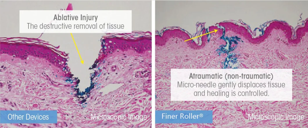 MS540 New Generation Finer Dermaroller with 33G Needles